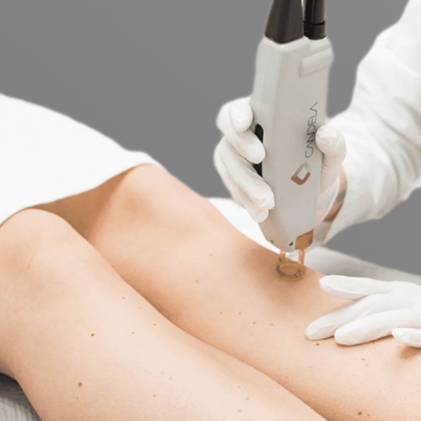 تقنيات ليزر إزالة الشعر جلسة ليزر إزالة الشعر في عيادات رفال بالقصيم باستخدام أحدث التقنيات